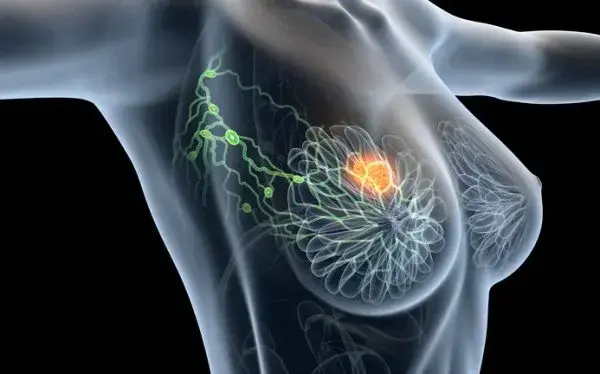 cancer screening female chest
